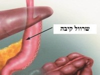 איך  לשמור על משקל תקין  לאחר ניתוח הרזיה?
